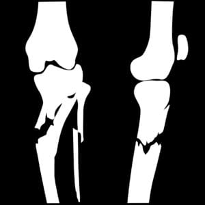 Bone Fractures - orthopedic care