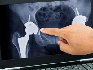 joint replacement benefits