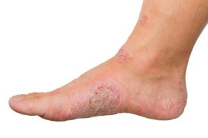 Isolated human foot and white background. Ulcers and infection of medical concepts.